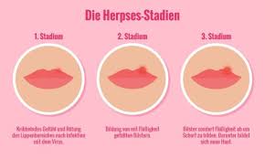 Pin On Herpes Treatment