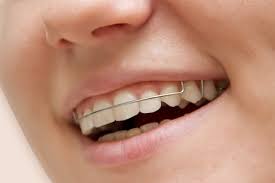 You may not notice that there's a problem with your teeth, which allows the cavity to grow. Do You Need To Wear A Retainer Forever Lincoln Park Smiles