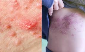 Image result for Panniculitis