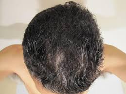 5 out of 5 stars. New Axe Pomade And Styling Paste Cause Hairloss Hairlosstalk Forums