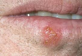 Image result for oral herpes symptoms roof of the mouth