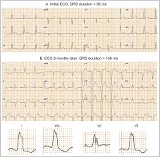 Image result for Left Bundle Branch Block
