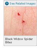 Black widows thrive in temperate climates, so they are. 7 Treating Spider Bites Ideas Spider Bites Treating Spider Bites Brown Recluse Spider