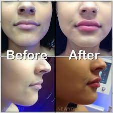 If a bump or cystic acne is causing swelling on the lips, the dermatologist may have to check for lumps in your lips or any other growth. New You Only Works With The Quality Dermal Filler That Has Been Specifically Engineered For Lip Augmentation Lippenstift Fur Helle Haut Lippenvergrosserung Haut