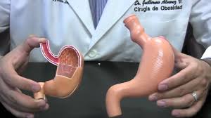 Youtuber explores how much food the human stomach can hold. How Big Is My Stomach Vsg Question And Answers Gastric Sleeve Doctor Youtube