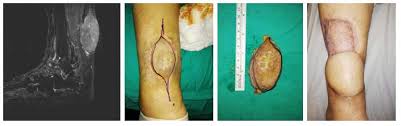 Image result for Leiomyosarcoma