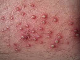 Image result for folliculitis symptoms