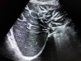 Periportal Fibrosis In Cholangitis Medical Ultrasound Ultrasound Sonography Diagnostic Medical Sonography