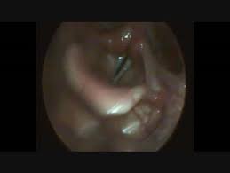 Image result for Functional Aphonia