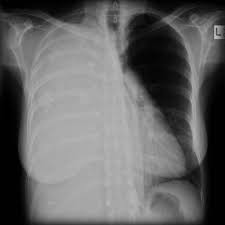 J cancer res clin oncol 118 (7): Mesothelioma Sarcomatoid Radiology Case Radiopaedia Org