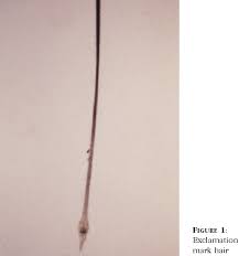 We did not find results for: Figure 1 From Alopecia Areata A Revision And Update Alopecia Areata Revisao E Atualizacao Semantic Scholar