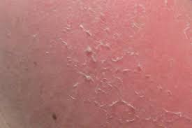Image result for Dry Skin
