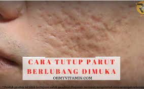 Dah puas cari cara hilangkan parut jerawat berlubang dengan berkesan. Cara Tutup Parut Berlubang Dimuka Coach Bisnes Coach Detox Kurus Coach Penyusuan Susu Ibu Mentor Bisnes Pengedar Shaklee Pengedar Youth Pengedar Vivix 011 17547669