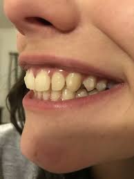 Of course, with the advancements in dentistry nowadays, there are many different ways to fix gaps in teeth. Too Much Of A Gap Made With Ipr When Can I Expect It To Close Photos