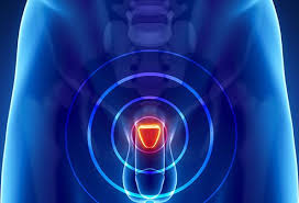 Early prostate cancer usually causes no symptoms or signs. Bph Enlarged Prostate Warning Signs Symptoms Surgery Cure