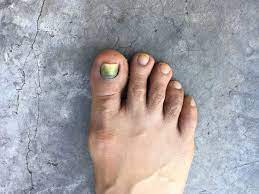 The tumor grows slowly, and can reach a maximum of about 4 cm. Toenail Disorders During Chemotherapy Prevention And Care