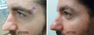 Laser Birthmark Removal in NYC and Long Island