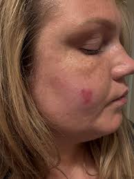 How to get rid of staph?