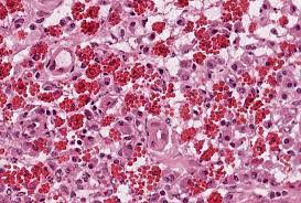 They occur frequently in plasma cells in. Russell Bodies Germinal Centers Scoring Imaging Hss