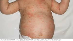 Image result for sweat rash on back baby