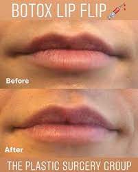 Can you botox lips to get a plumper lip? Botox Lip Flip Or Lip Fillers Which Is Right For You