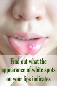 The simplest way to treat red bumps on your mouth is to see a doctor. Small Bumps On Your Lips And Inside Your Mouth Are Actually Quite Common Learn About Different Types Of The Blister On Lip Health And Fitness Tips Mouth Sores