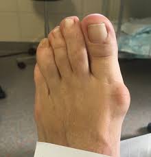 Was ist ein hallux valgus winkel und wann ist eine op von nöten. Hallux Valgus Ursachen Diagnose Und Behandlung In Der Praxisklinik Orthospine