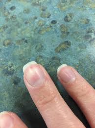 A narrow black line that has formed vertically underneath your nails is called a splinter hemorrhage. What Is This Tiny Black Line In My Nail Just Appeared And I Regret Googling It Redditlaqueristas