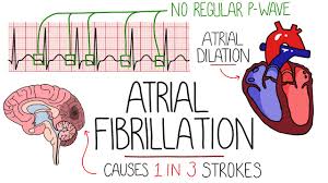 Image result for Atrial Fibrillation