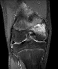 Image result for Osteomyelitis