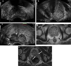 It required the doctor to take an average of 12 random samples in the hopes of finding the cancer. Prostate Cancer Detection And Diagnosis Role Of Ultrasound With Mri Correlates Springerlink