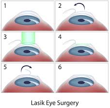 Examples include sealing leaking blood vessels, reducing pressure in the eye, replacing the cornea, and removing part of the iris. Laser Surgery Advice Norwest Optometrist Vision Excellence