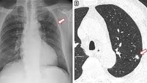 Image result for lung cancer xray