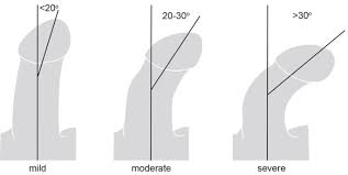 Image result for Chordee