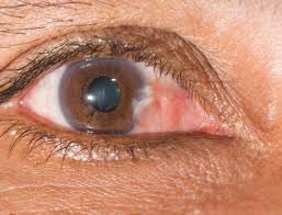 1 paupière qui tremble ou saute : Tremblement Des Paupieres Causes Et Traitement