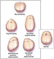 Craniosynostosis My Son Was Born With Severe Metopic Cranio Trigoncephaly Orthotics And Prosthetics Prosthetics Pediatry