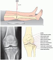 Image result for Knee XRay