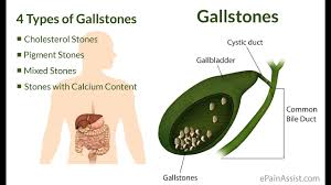 When pain occurs, the doctor will order an ultrasound exam to look for gallstones. Drinking Apple Cider To Flush Out Gall Bladder Stones Eng Sub Youtube