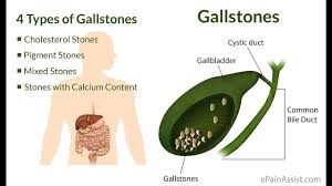 Apple juice and apple cider vinegar for gall stones. Drinking Apple Cider To Flush Out Gall Bladder Stones Eng Sub Youtube