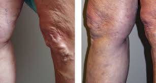 Only the person booked should attend the appointment. Varicose Vein Treatment Lakeshore Vein Aesthetics Clinic Pre Post Images Before After Photos