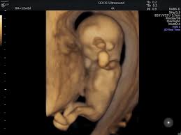 If you're pregnant in england you'll be offered an ultrasound scan at around 10 to 14 weeks of pregnancy. 12 Week Scan Pogu