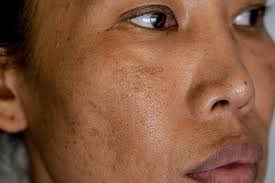 Image result for Melasma