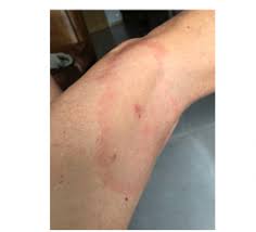 L'érythème migrant est pathognomonique d'un début de maladie de lyme par morsure de tique. La Maladie De Lyme Forest Time