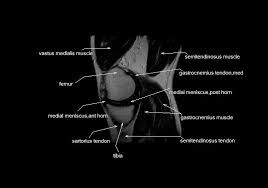Magnetic resonance imaging is particularly well suited for the medical evaluation of the musculoskeletal (msk) system including the knee, shoulder, ankle, wrist and elbow. Mri Knee Anatomy Anatomy Drawing Diagram