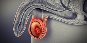 That's why we need to take it so seriously. Testicular Cancer Testicular Cancer Pictures Testicular Cancer Treatment