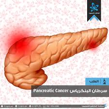 Symptoms include jaundice and abdominal pain, but these might not appear until the later stages. Ø§Ù„Ø¨Ø§Ø­Ø«ÙˆÙ† Ø§Ù„Ø³ÙˆØ±ÙŠÙˆÙ† Ø³Ø±Ø·Ø§Ù† Ø§Ù„Ø¨Ù†ÙƒØ±ÙŠØ§Ø³ Pancreatic Cancer