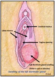 Image result for Bartholin's gland abscess
