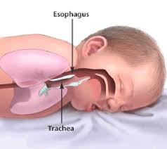 A síndrome de morte súbita infantil (smsi), também conhecida como síndrome de morte súbita dos lactantes (smsl), é a principal causa de morte entre bebês até o primeiro ano de vida. Enfermagem Na Saude Da Crianca E Do Adolescente Ii Uff Facebook