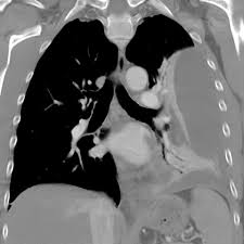 Diagram of fluid buildup in the pleura. Large Loculated Pleural Effusion 3 Of 3
