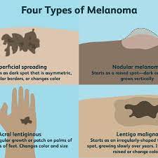 Check spelling or type a new query. Melanoma Overview And More